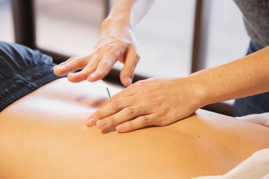 Acupuncture in Barrie