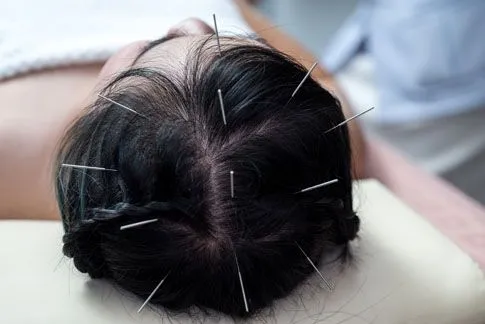 Acupuncture in Barrie